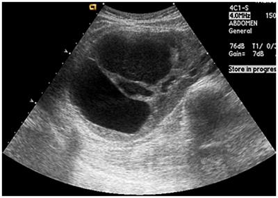 Xanthogranulomatous pyelonephritis in a patient with polycystic kidney disease without underlying risk factors: a case report